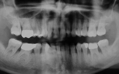 Iatrogene Hindernisse durch Zahnersatz