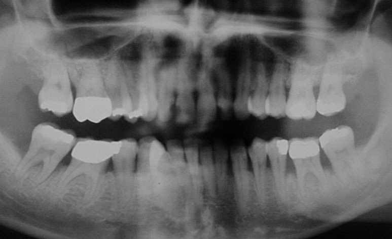 Iatrogene Hindernisse durch Zahnersatz