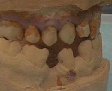 Myoarthropathie bei progenem Zwangsbiss