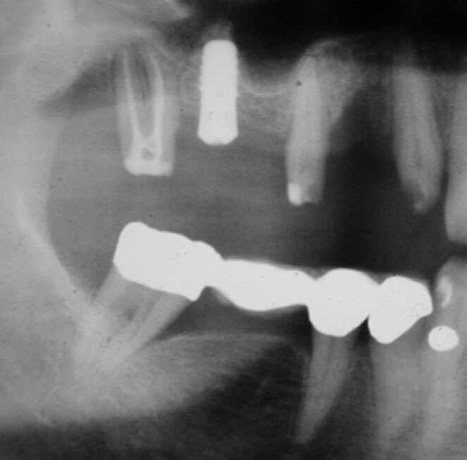 2. Fallbeispiel Implantate