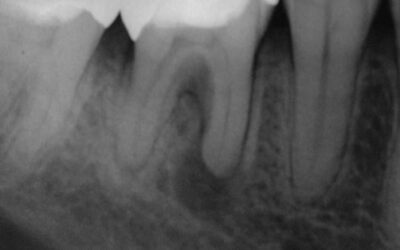 Coronal Leakage 3