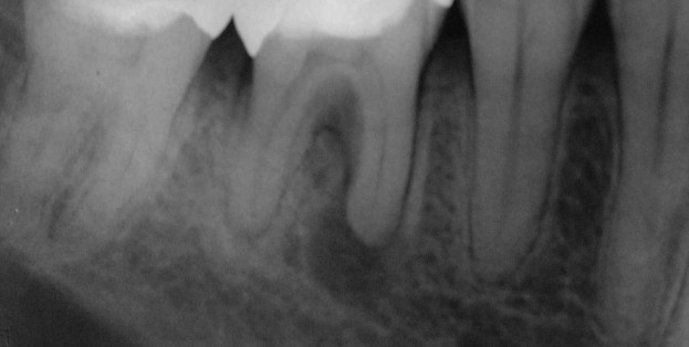 Coronal Leakage 3