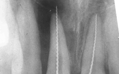 Der Platinstandard in der Endodontie