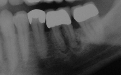 Periimplantitis-Tsunami?