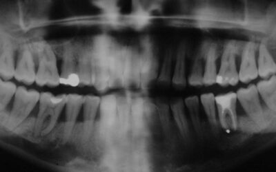 Parodontitis und Bruxismus