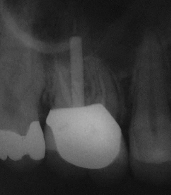 Diastema